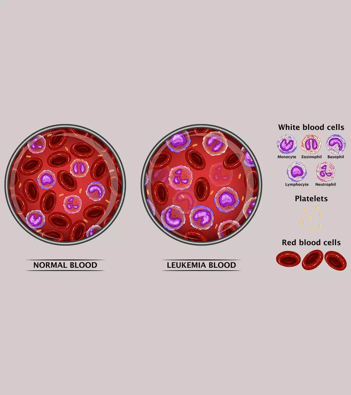 Leukemia In Teens Symptoms Treatment1