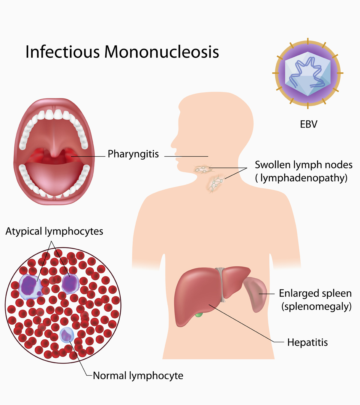 Mononucleosis (Mono) In Teens: Causes, Symptoms & Treatment