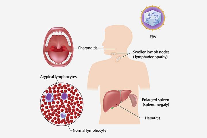 Mononucleosis Mono In Teens Causes Symptoms Treatment