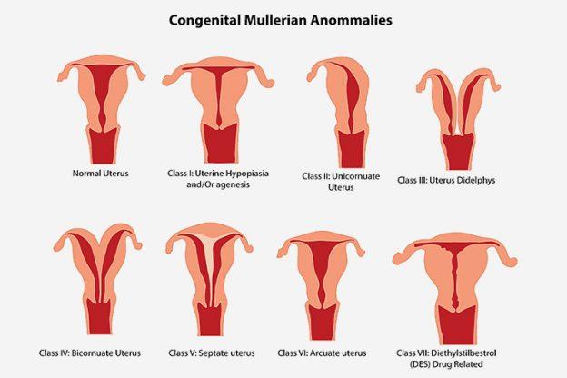 uterine-abnormalities-during-pregnancy-classification-symptoms-treament