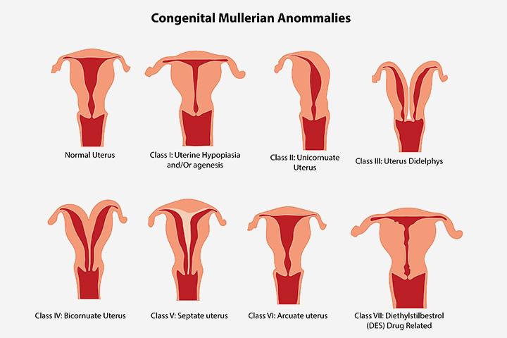 Uterine Abnormalities During Pregnancy Classification Symptoms