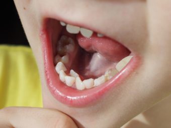 6 Causes Of Hyperdontia (Extra Teeth) In Children And Treatment Options