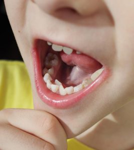6 Causes Of Hyperdontia (Extra Teeth) In Children And Treatment Options