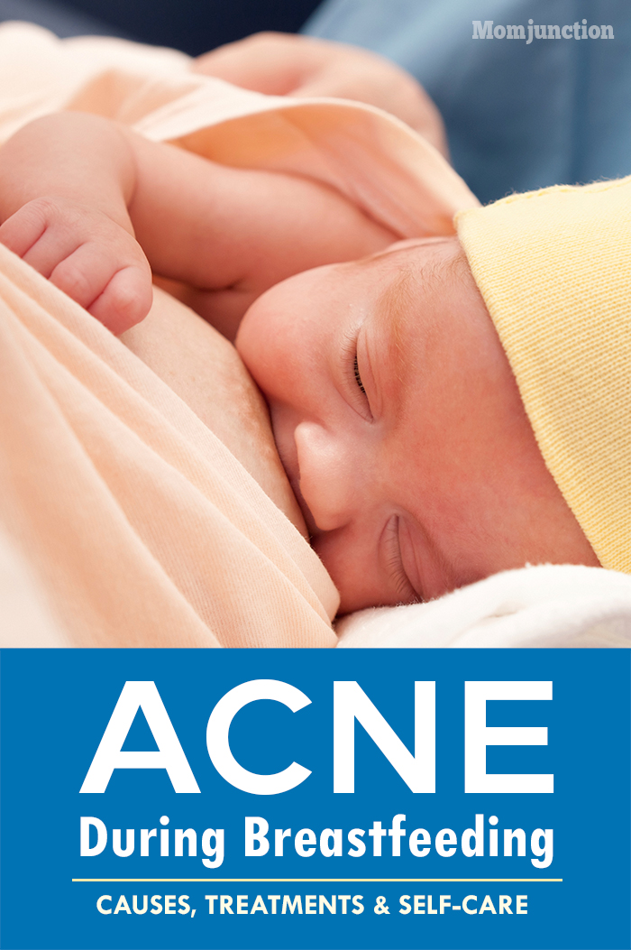 Acne While Breastfeeding - Causes, Treatments And Self-care