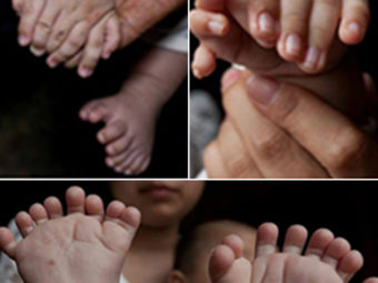Baby Born With 31 Fingers And Toes In China