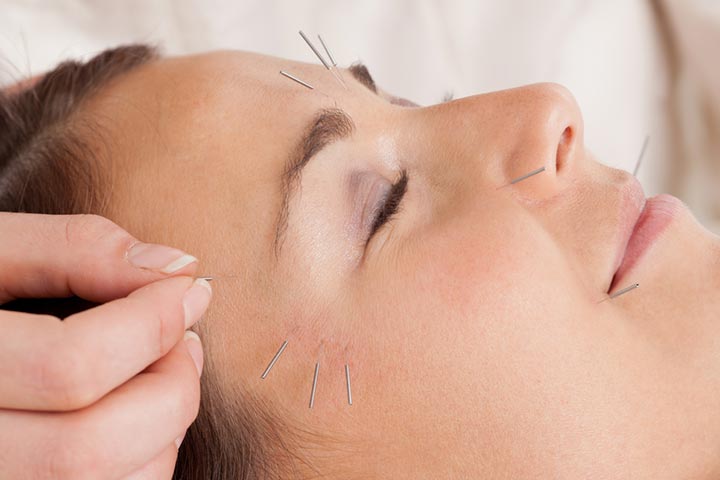 Facial cosmetic acupuncture is a safe alternative to botox in breastfeeding mothers.