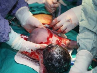 Here's Why A Mom Shouldn't Regret A C-section
