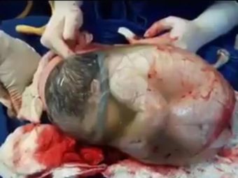Rare Video Post Shows A Baby Born In Its Amniotic Sac