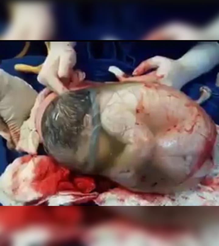 罕见的视频阿宝st Shows A Baby Born In Its Amniotic Sac