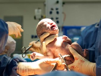 C-Sections Could Affect Genetics Of Your Pelvis