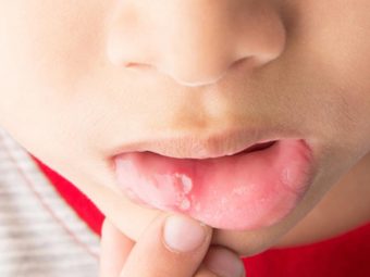 Canker Sores In Children - Causes, Treatment And Remedies