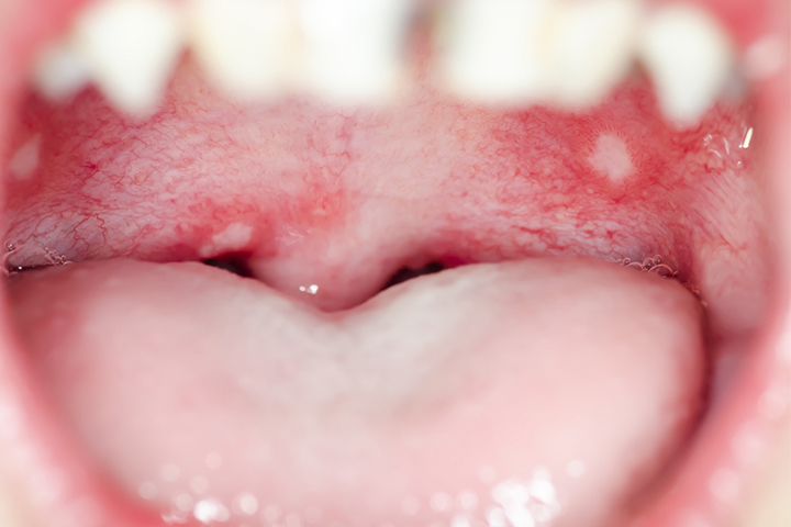 Canker sores in kids 