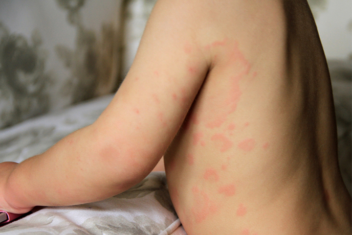 Hives in children cause rashes 