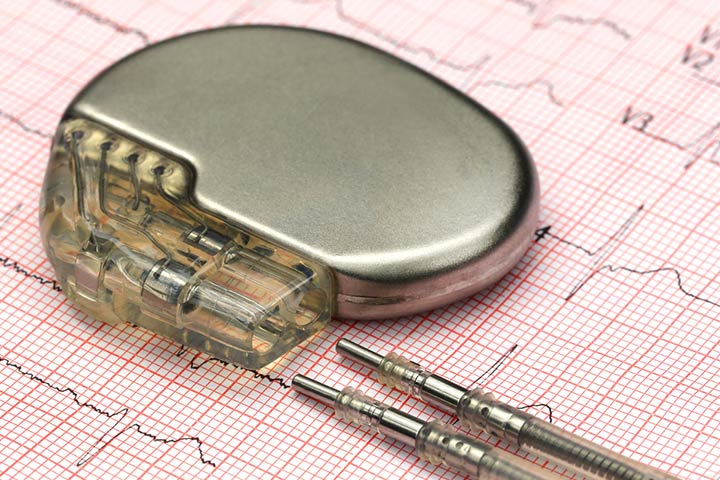 Arrhythmia in children can be treated with a pacemaker