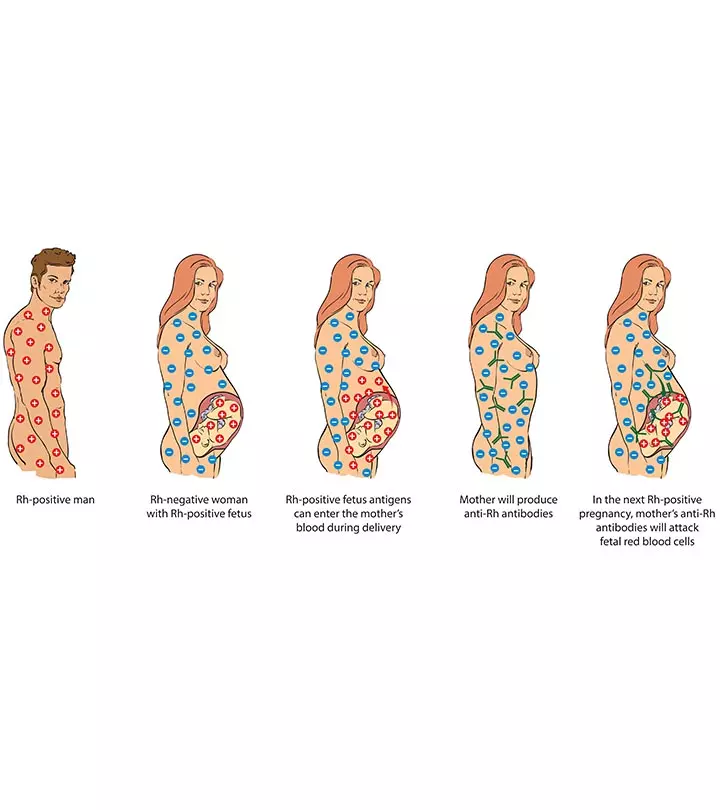 Rh Mismatch: What Does It Mean To You And Your Baby?