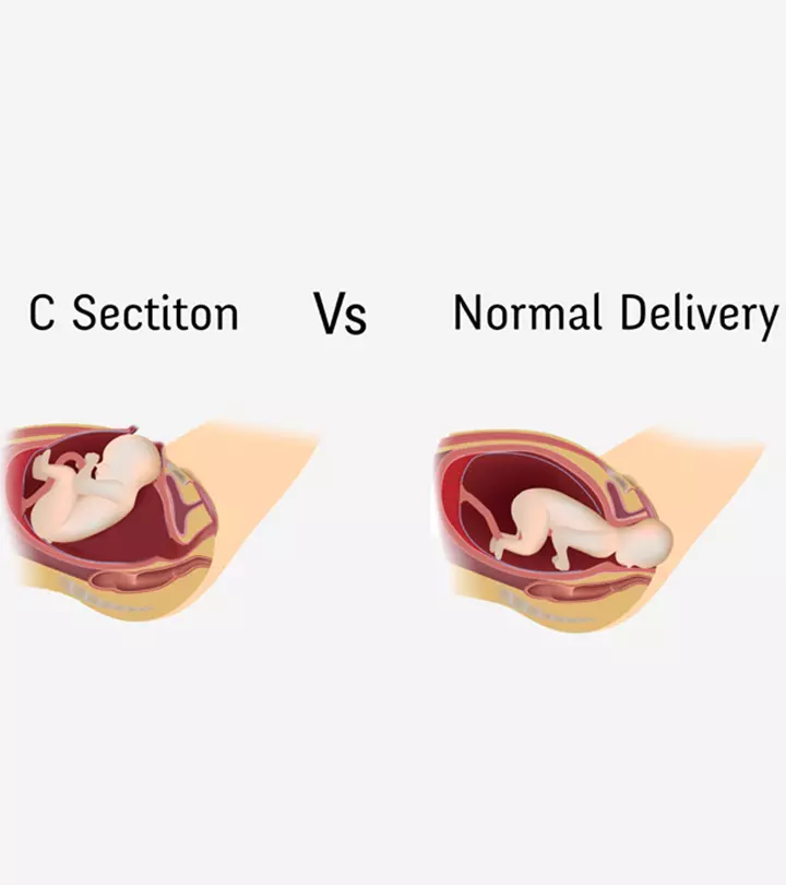 Normal Delivery Vs Cesarean – Risks And Benefits