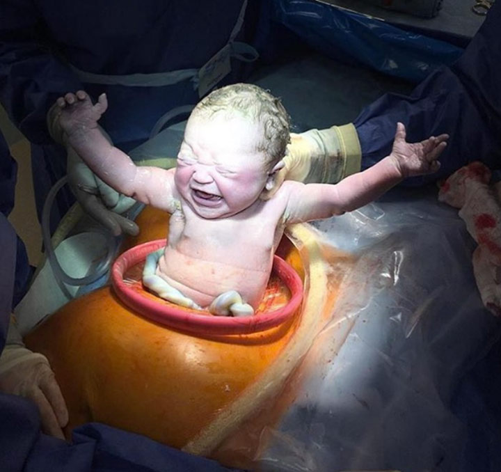 Stunning C-Section Photo Sums Up The Magic Of Childbirth1