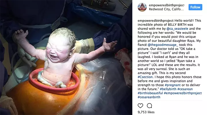 Stunning C-Section Photo Sums Up The Magic Of Childbirth2