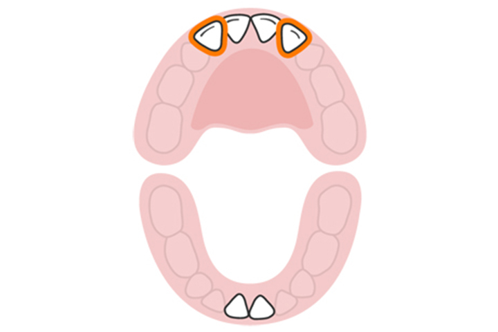 The lateral incisors (upper)