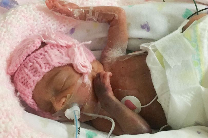 This Premature Baby Is A Miracle