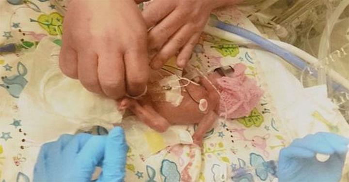 This Premature Baby Is A Miracle2