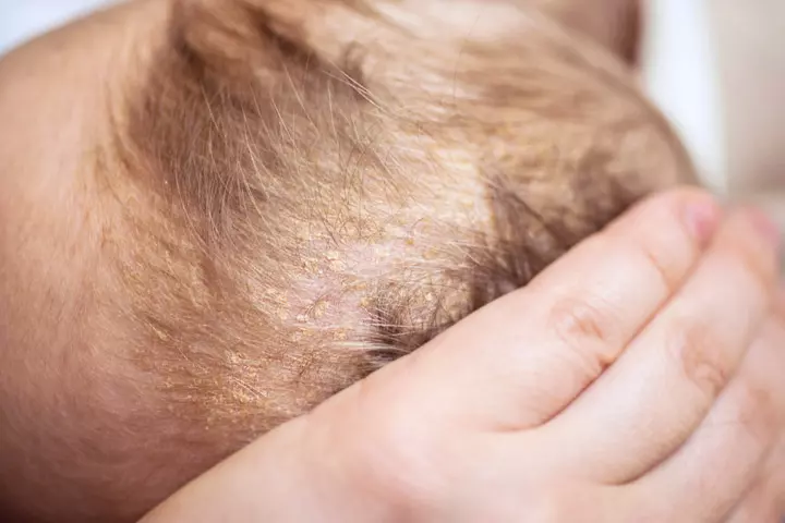 cradle cap