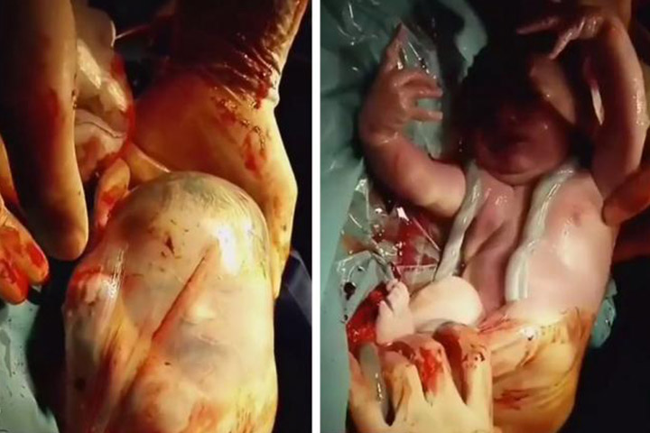 En Caul Birth Breathtaking Video Of Baby Being 'Unwrapped’ After Birth (2)