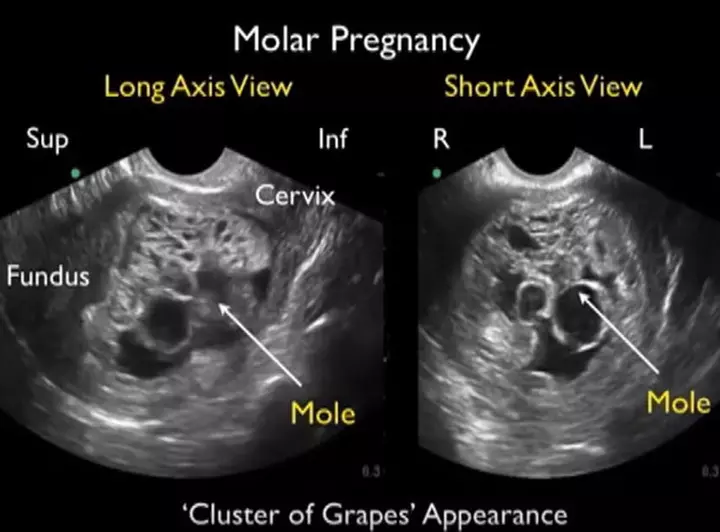 Mother’s Pregnancy Test Is Positive. What Doctors See Is ‘Grapes’ Instead Of Baby (4)