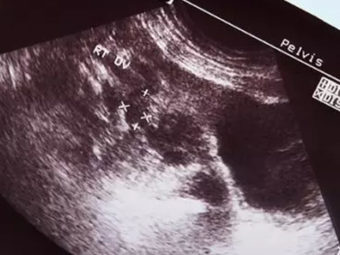 Mother’s Pregnancy Test Is Positive. What Doctors See Is ‘Grapes’ Instead Of Baby