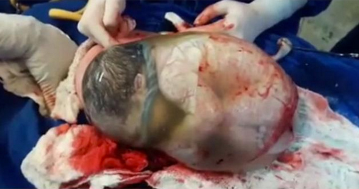 Video Of A Newborn Still INSIDE The Amniotic Sac. Watch How Doctors Cut it!1