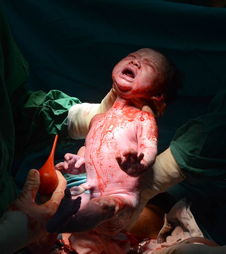10 Reasons Doctors Opt For C-Section: What You Should Know