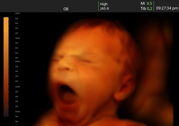 Ever Seen Fetuses Yawning In Womb? Must Watch Video!