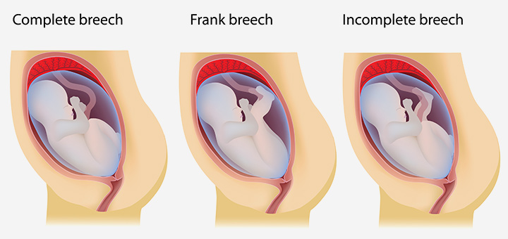 If the baby is in breech position
