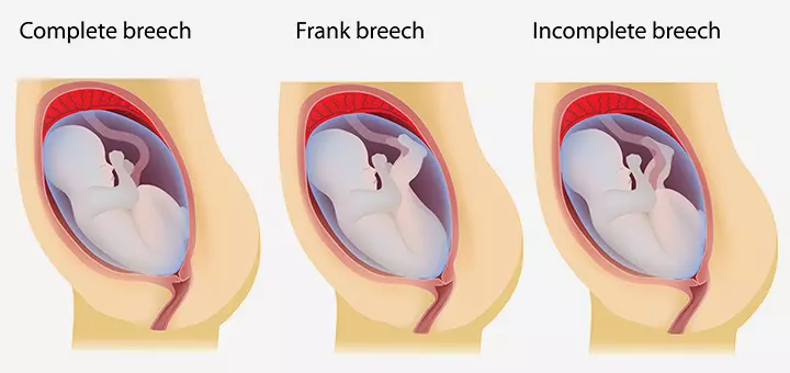 If the baby is in breech position If the baby is in breech position