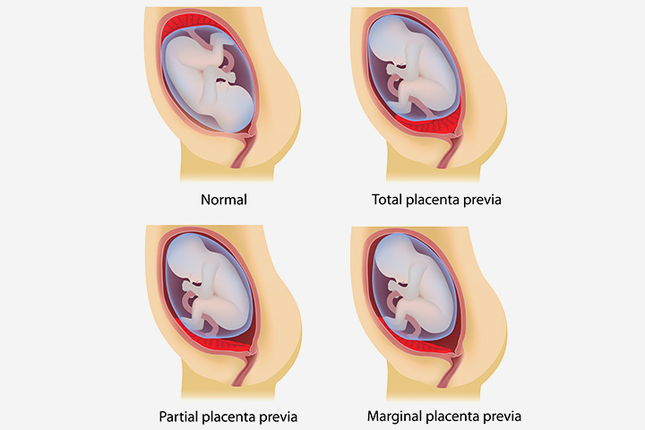 If there are placenta issues