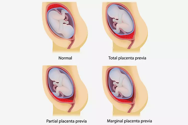 If there are placenta issues If there are placenta issues