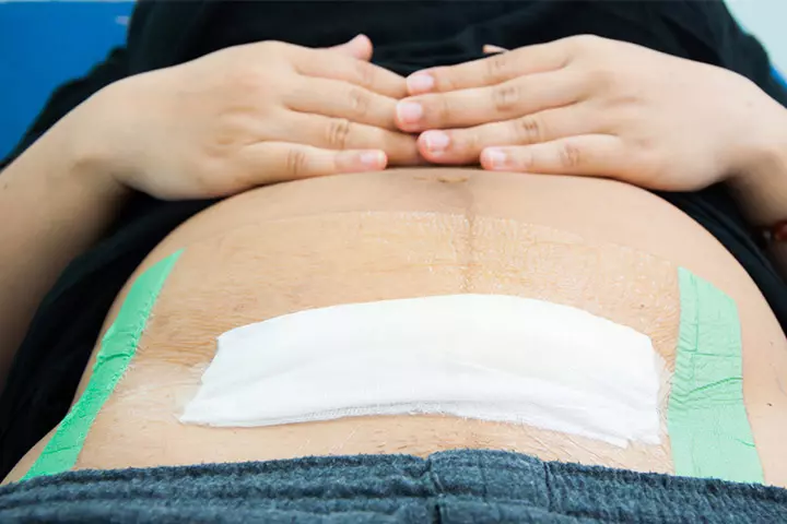 Warning Signs To Look For After C-Section Surgery1