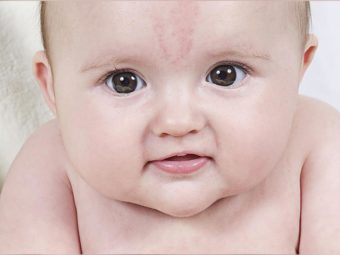 Birthmarks In Babies: What Are The Types? When Should You Worry?