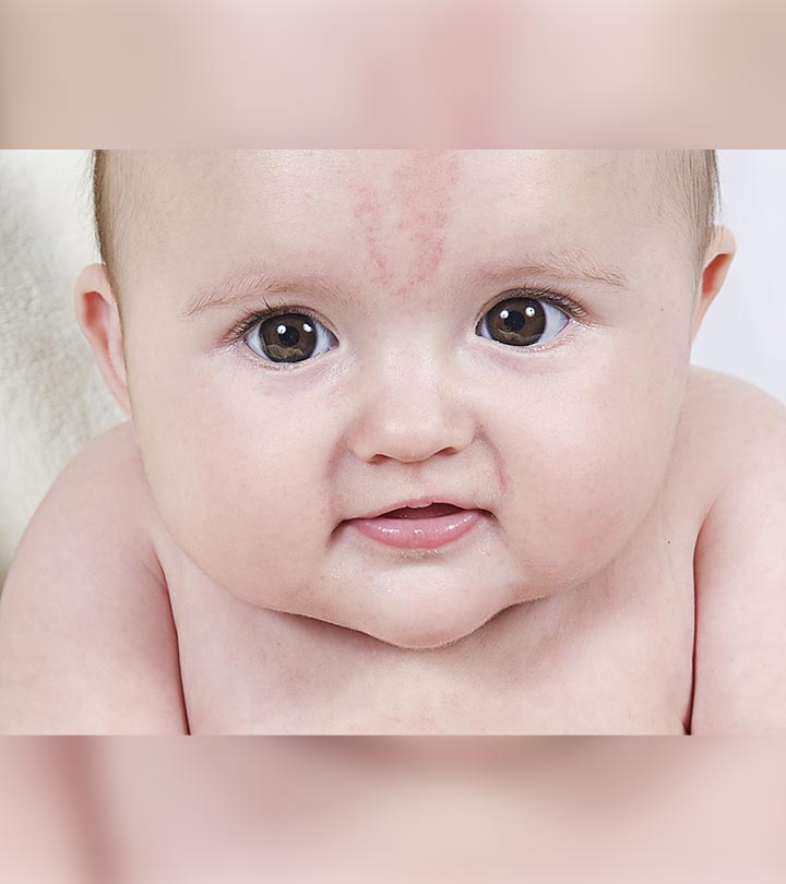 Birthmarks In Babies: What Are The Types? When Should You Worry?
