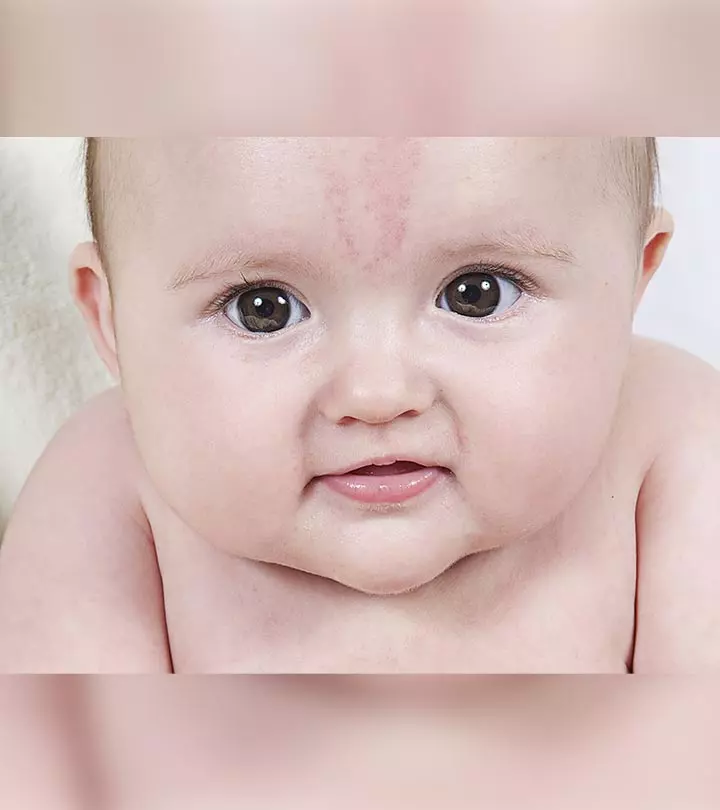 Birthmarks In Babies What Are The Types When Should You Worry