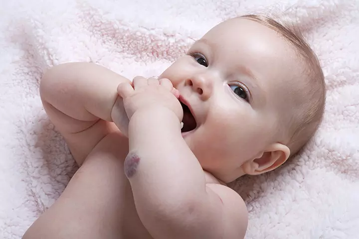 Hemangioma Hemangioma