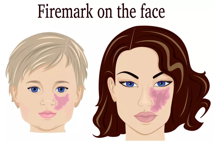 Port-wine stains Port-wine stains