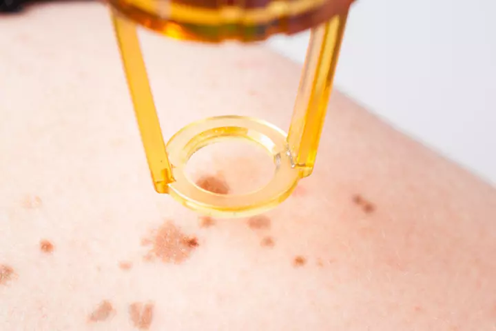 Should You Remove Or Treat Birthmarks Should You Remove Or Treat Birthmarks