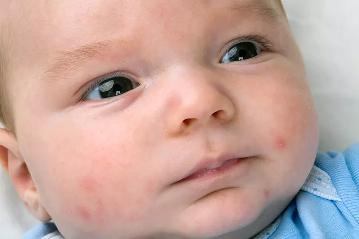 Babies Get Acne Too