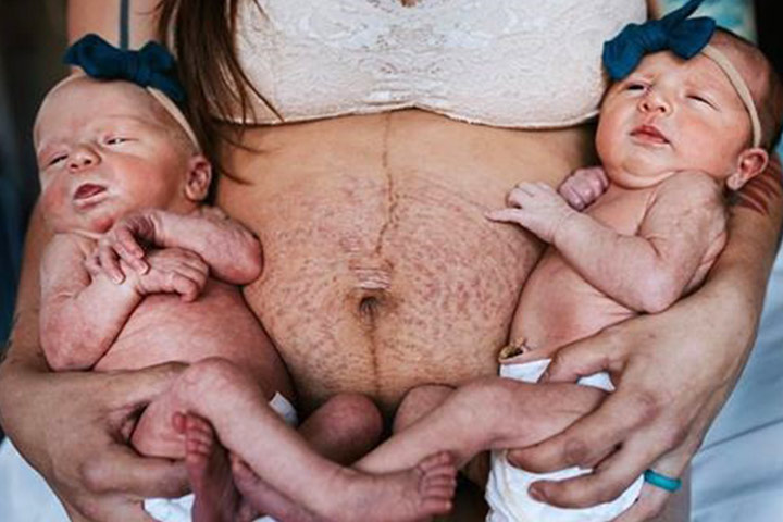 Mother Shares Raw Photos Of Stretch Marks