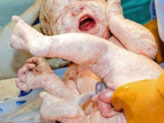 C-Section Birth Photos That Will Make You Go ‘Wow’