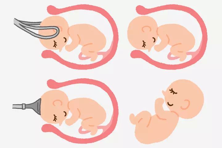 What Happens During A Forceps-Assisted Birth What Happens During A Forceps-Assisted Birth