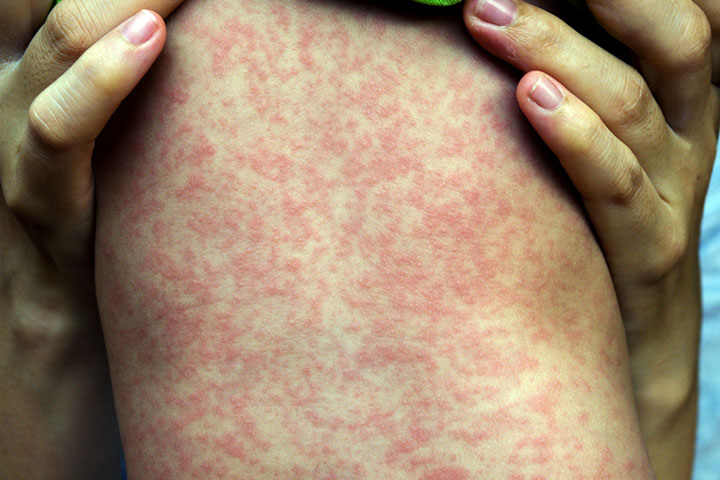 Considering Measles And Roseola The Same