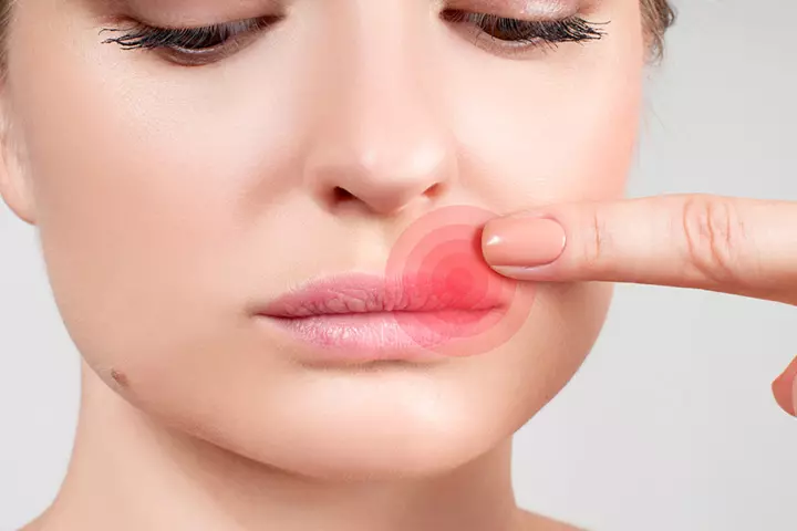 Herpes Simplex Virus The Reason For Cold Sores Herpes Simplex Virus The Reason For Cold Sores