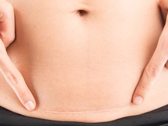 What Really Happens To Your Stomach After A Cesarean?